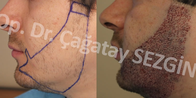 Dr-Cagatay-Beard hair transplant